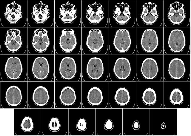 计算机断层扫描 Ct 射线照相 - 上的免费图片