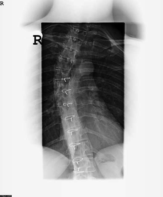 X 射线图像 骨 脊柱 - 上的免费照片