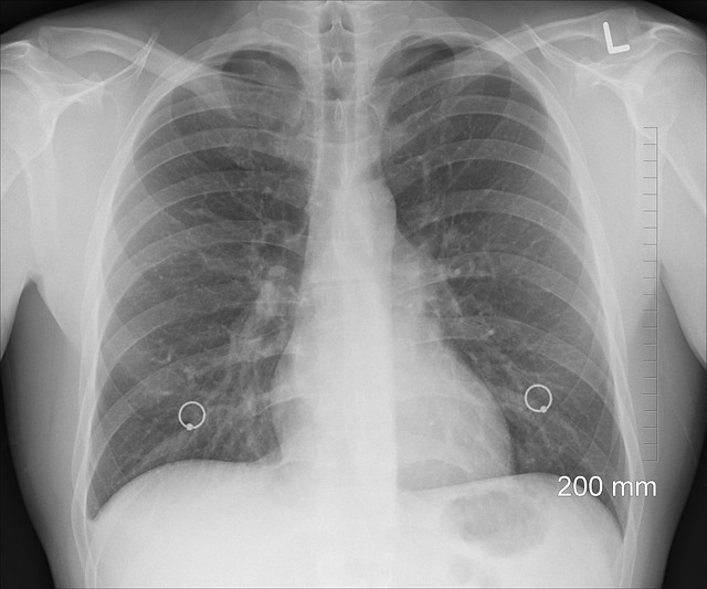 诊断 X射线 胸部 - 上的免费照片