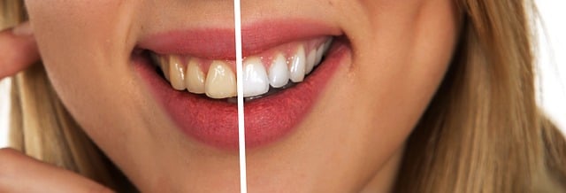 牙齿 牙科护理服务 白色的 - 上的免费图片