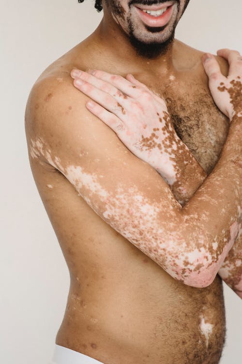 作物性格开朗的赤膊男子与白癜风 · 免费素材图片