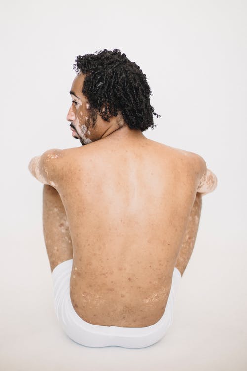 光着膀子的非洲裔美国人患有白癜风的皮肤状况 · 免费素材图片