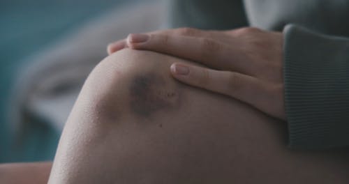 有关手, 挫伤, 握住的免费素材视频